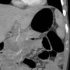 Arterial phase computed tomography demonstrates a small pseudoaneurysm