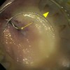 Endoscopic view of the angled guidewire protruding through the fistula and the over-the-scope clip