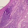 Stratified squamous epithelium, sebaceous units, and surrounding lymphocyte infiltration