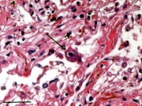 The lungs show intestinal pneumonitis
