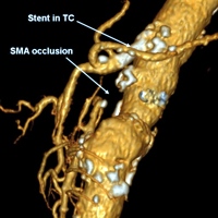 Changes in functioning arterial collaterals after celiac trunk stenting