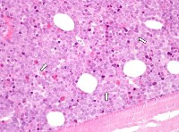 Bone marrow trephine at presentation