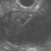 EUS-FNA image confirming successful puncture of the lymphoepithelial cyst